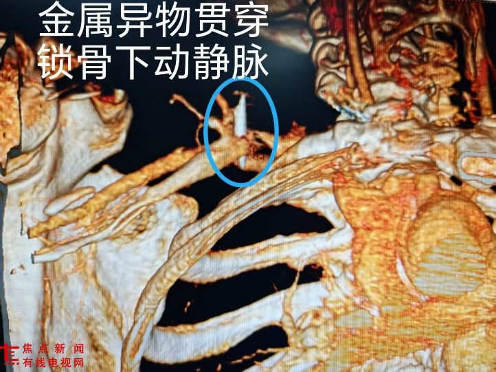 惊险！高温铁片刺穿大动脉，多学科协作巧妙 “拆弹”！